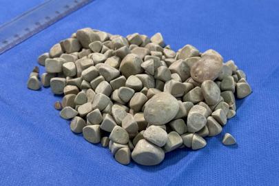 İstanbul'da karın ağrısıyla doktora gitti: Vücudunda 287 tane taş çıktı