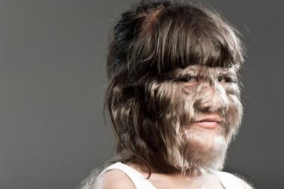 Nadir hastalıklara yüksek teknoloji umudu